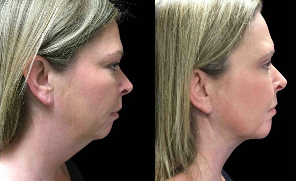 43-year-old-female-chin-implant-before-and-after-side-view.jpg