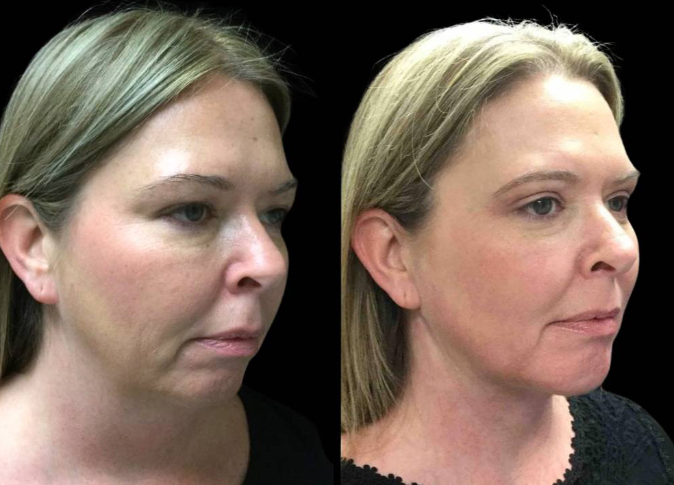 43-year-old-female-chin-implant-before-and-after-three-quarter-view.jpg