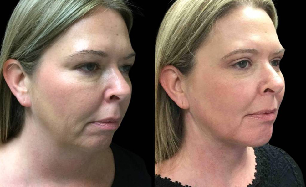 43-year-old-female-chin-implant-before-and-after-three-quarter-view.jpg