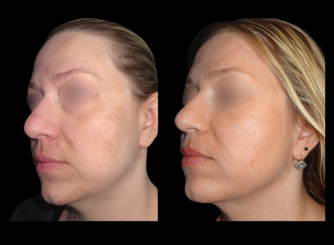 43-year-old-female-melanage-peel-before-and-after-143-year-old-female-melanage-peel-before-and-after.jpg