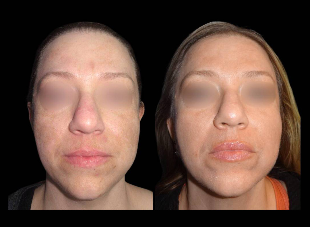 43-year-old-female-melanage-peel-before-and-after.jpg