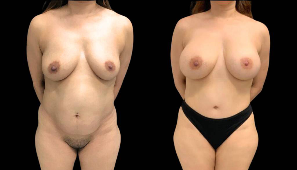 43-year-old-female-mommy-makeover-body-before-and-after-front-view-32679.jpg