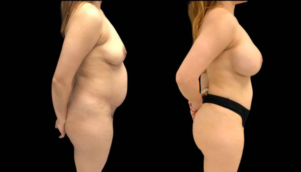 43-year-old-female-mommy-makeover-body-before-and-after-side-view.jpg