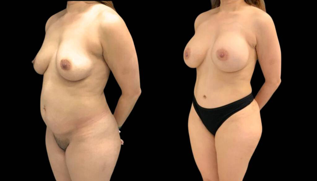 43-year-old-female-mommy-makeover-body-before-and-after-three-quarters-view.jpg