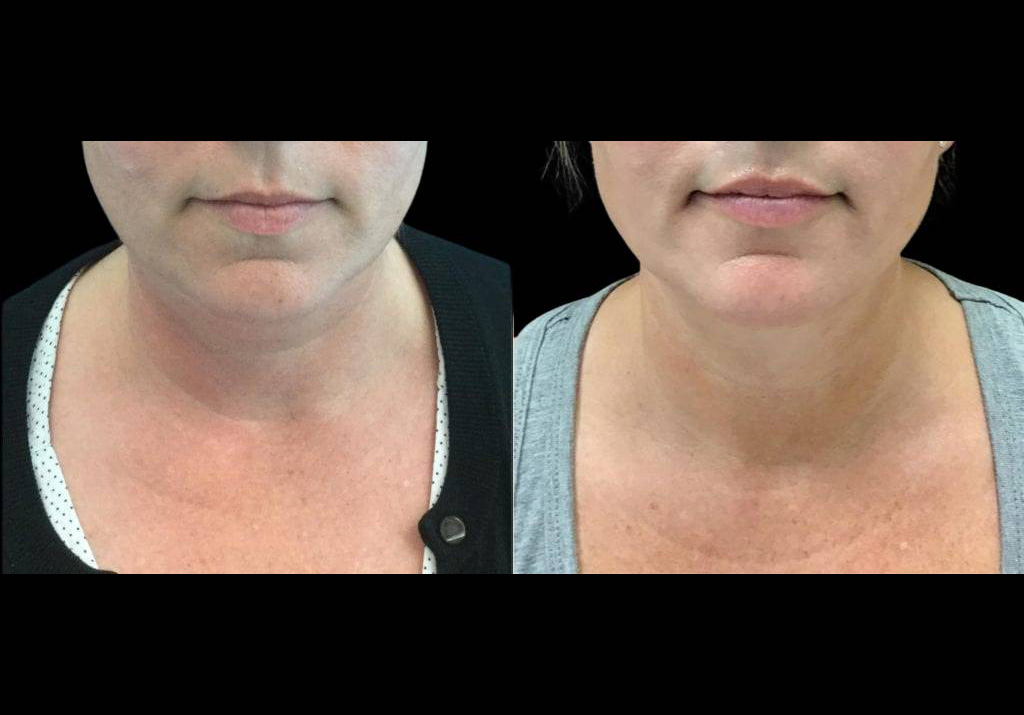 43-year-old-female-neck-liposuction-before-and-after-front-view-9437.jpg