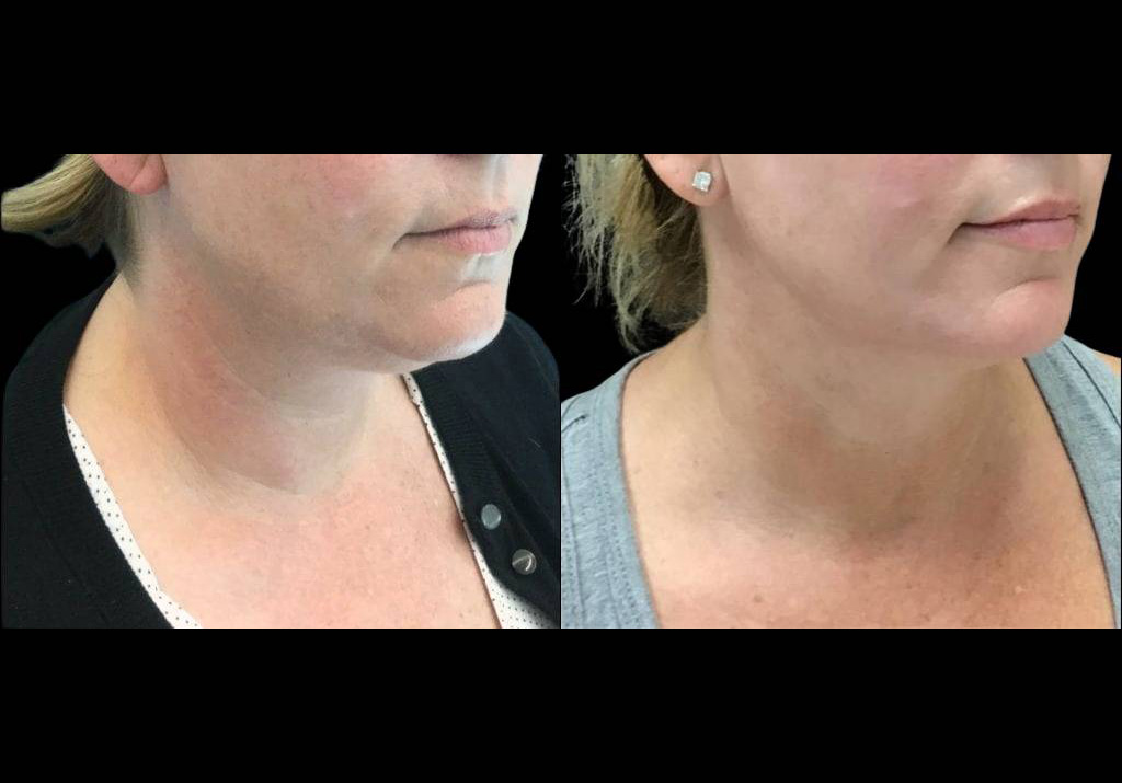 43-year-old-female-neck-liposuction-before-and-after-three-quarter-view.jpg