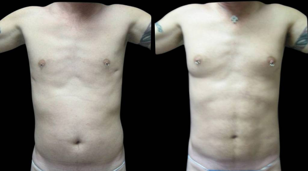 This is a 43-year-old male that has had an abdominal etching done showing the before and after's side-by-side