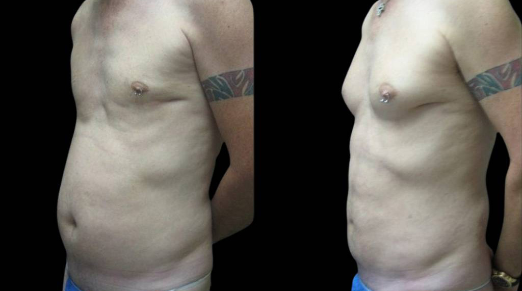 This is a 43-year-old male that has had an abdominal etching done showing the before and after's side-by-side
