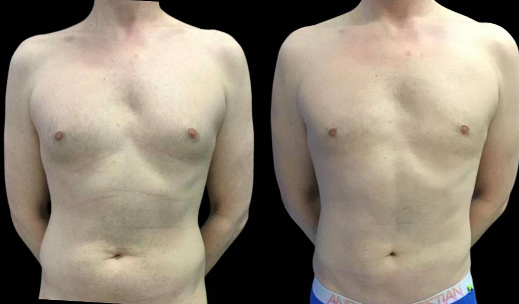 43-year-old-male-breast-reduction-before-and-after-front-view-25106.jpg