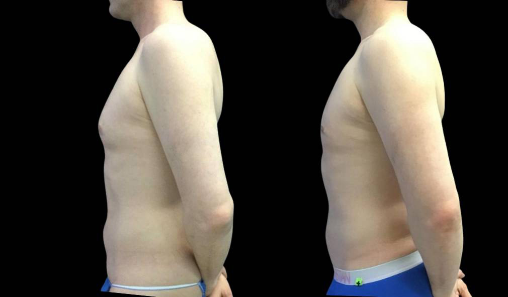 43-year-old-male-breast-reduction-before-and-after-side-view.jpg