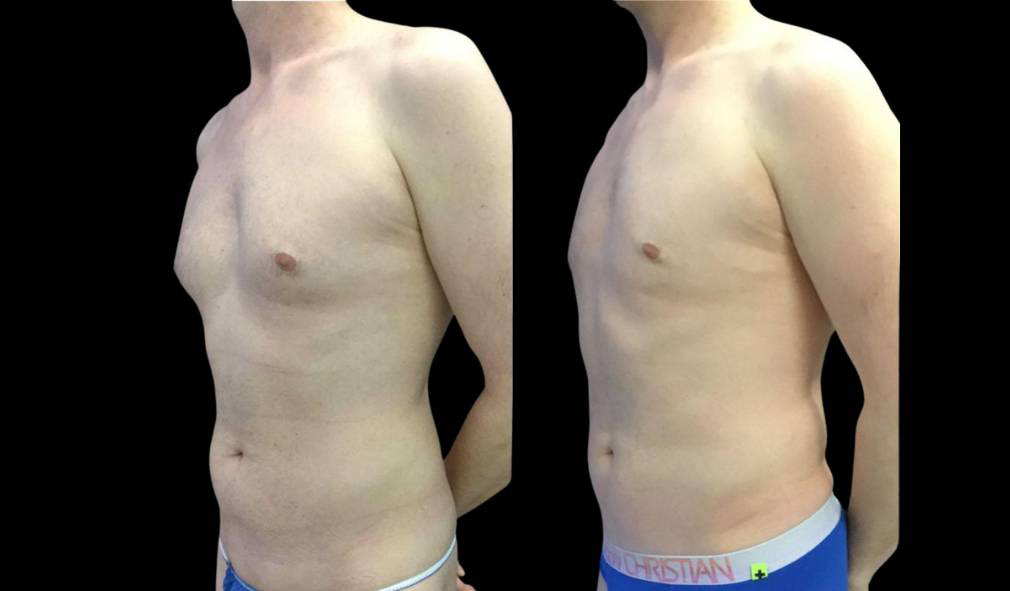 43-year-old-male-breast-reduction-before-and-after-three-quarter-view.jpg