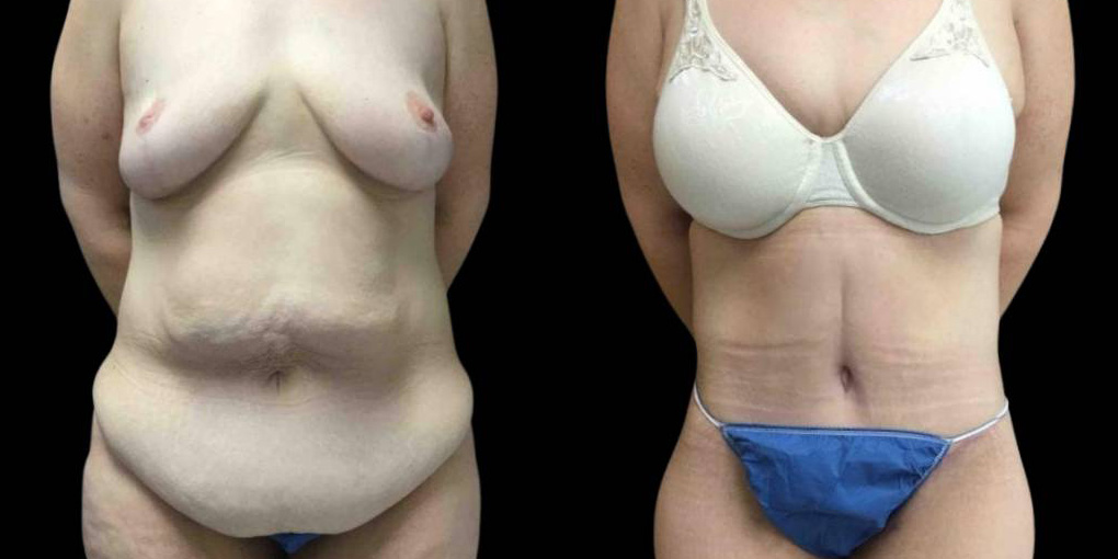 This is a 44-year-old female that has had a lower body lift, arm lift, and breast list after weight loss showing the before and after's side-by-side