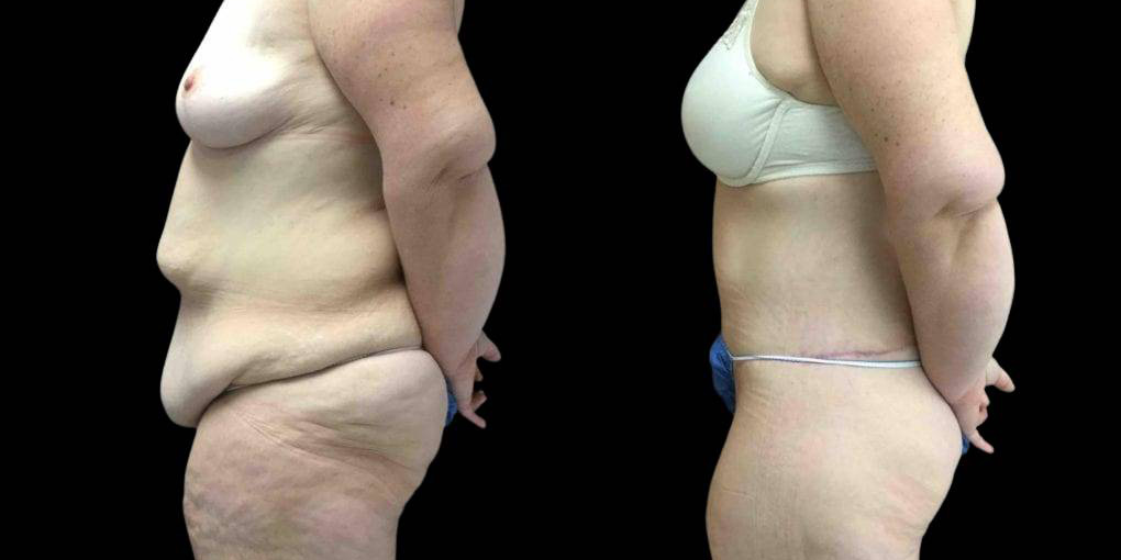 This is a 44-year-old female that has had a lower body lift, arm lift, and breast list after weight loss showing the before and after's side-by-side