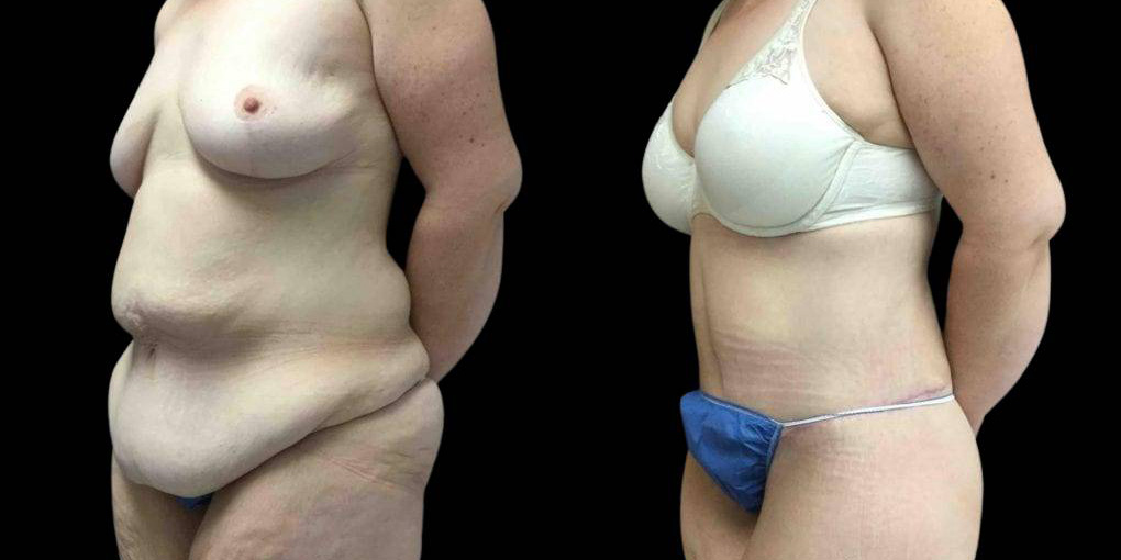 This is a 44-year-old female that has had a lower body lift, arm lift, and breast list after weight loss showing the before and after's side-by-side