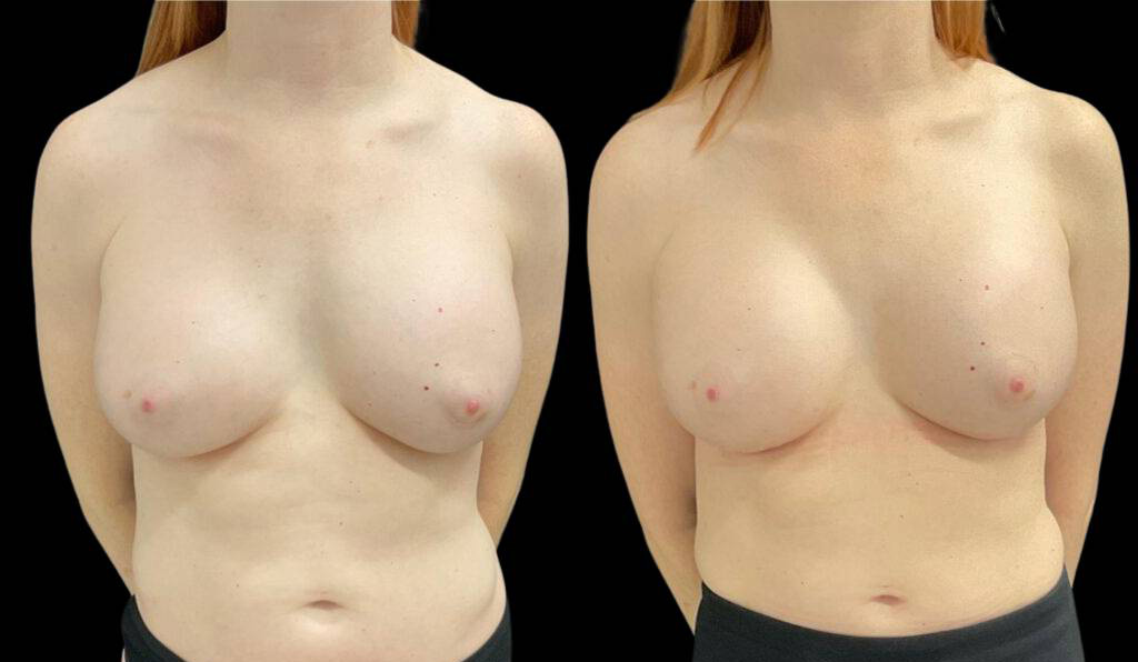 44-year-old-female-breast-implant-exchange-before-and-after-front-view-33033.jpg
