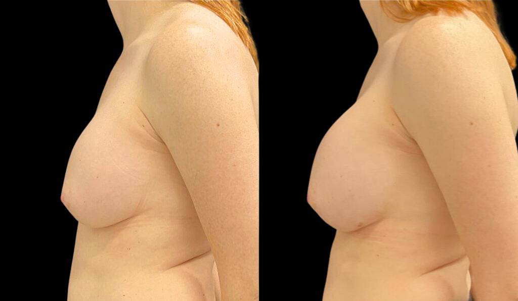 44-year-old-female-breast-implant-exchange-before-and-after-side-view.jpg