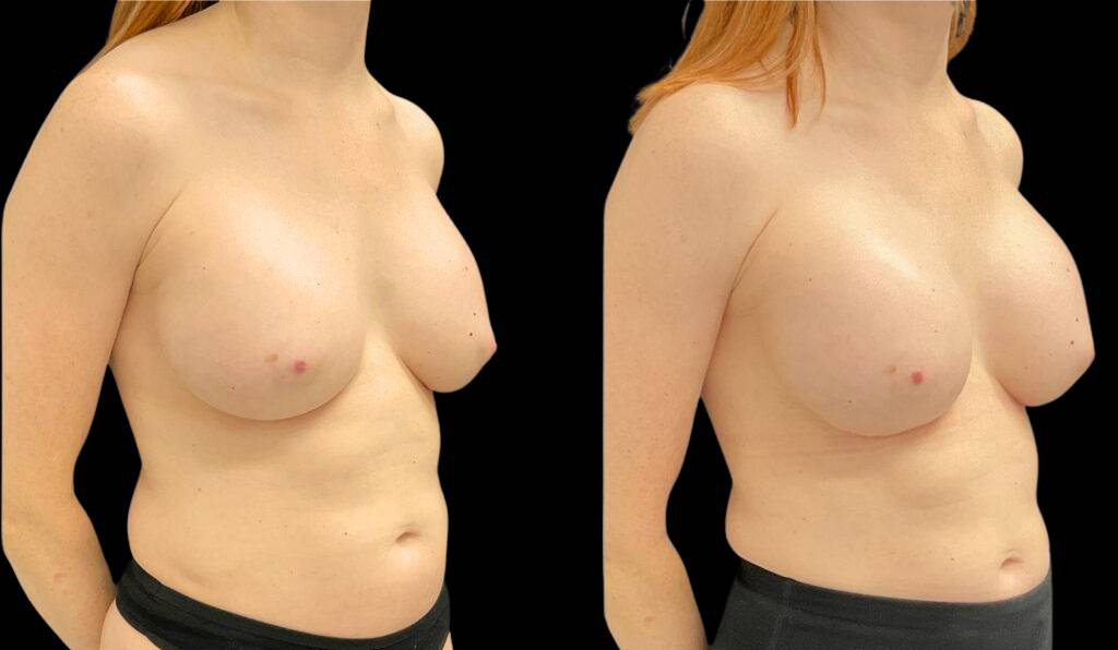 44-year-old-female-breast-implant-exchange-before-and-after-three-quarter-view-2.jpg