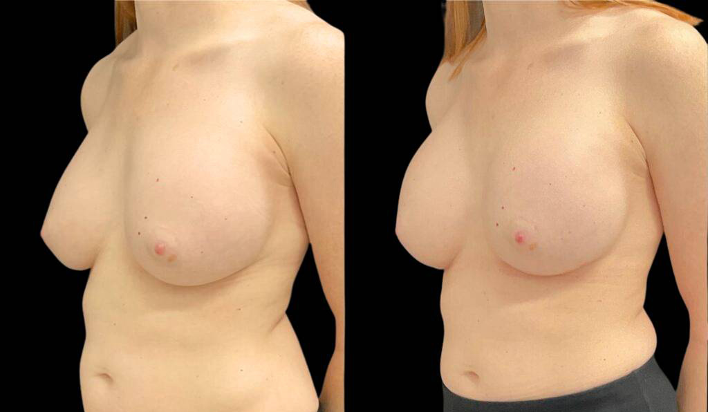 44-year-old-female-breast-implant-exchange-before-and-after-three-quarter-view.jpg