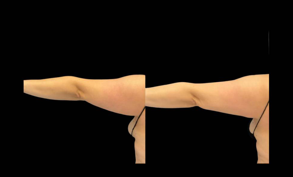 44-year-old-female-coolsculpting-before-and-after-arm.jpg