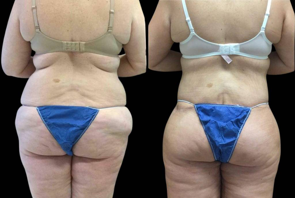 44-year-old-female-lower-body-lift-before-and-after-back-view.jpg