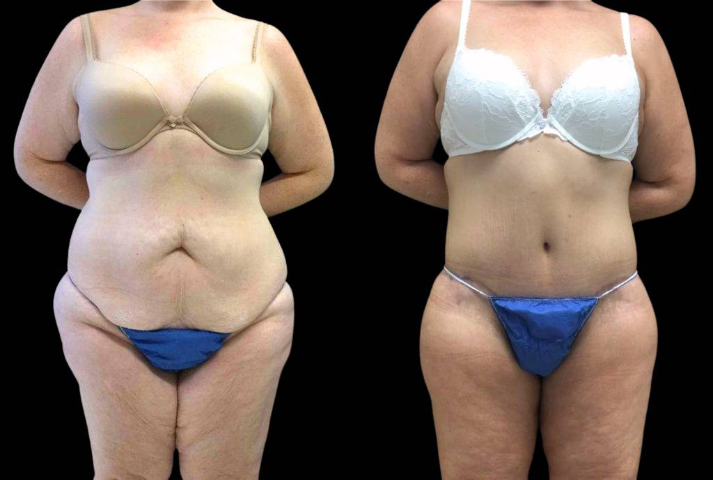 44-year-old-female-lower-body-lift-before-and-after-front-view.jpg