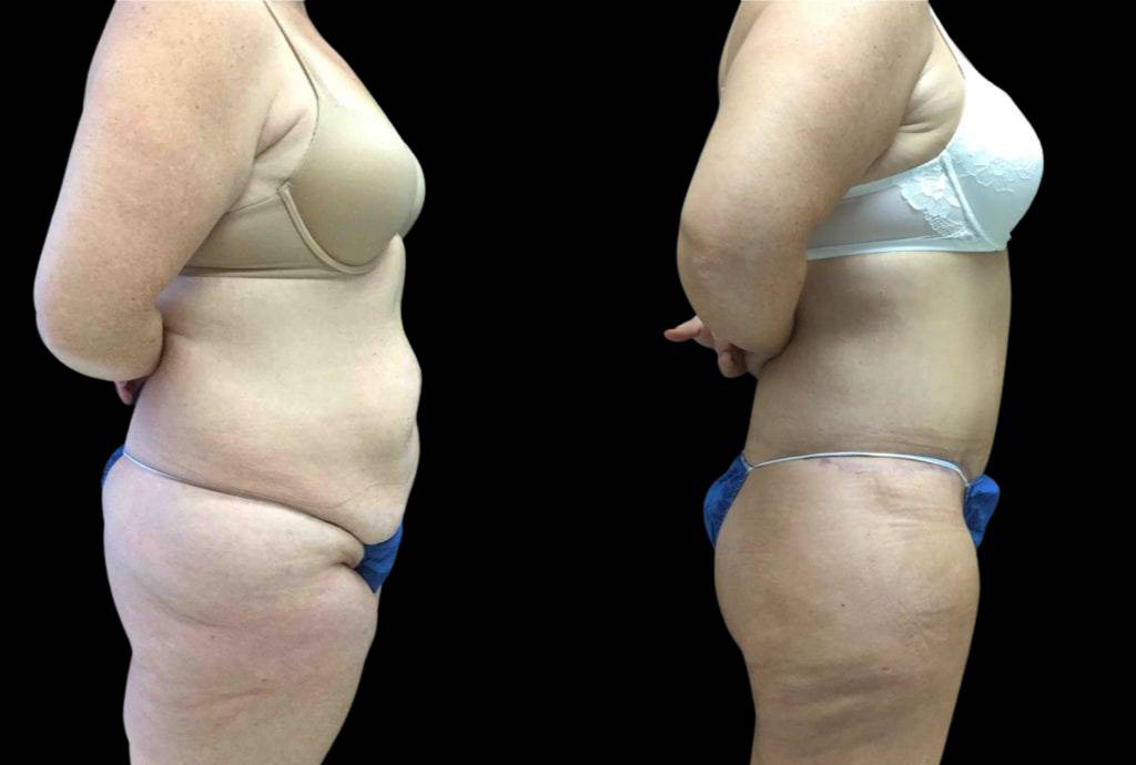 44-year-old-female-lower-body-lift-before-and-after-side-view.jpg