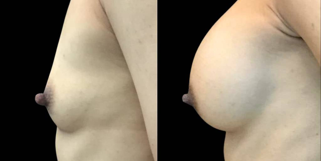 This is a 44-year-old female that has had a breast augmentation and implant showing the before and after's side-by-side