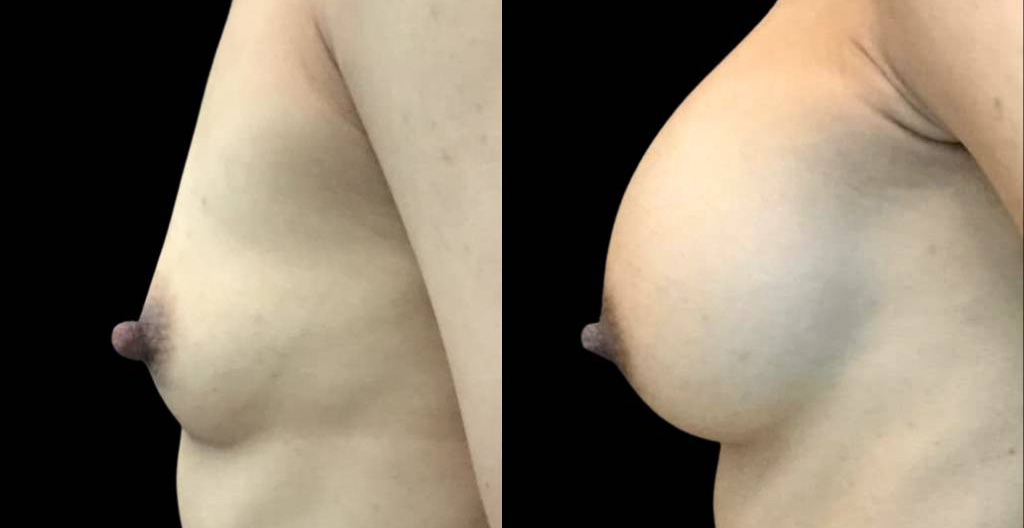 44-year-old-female-nipple-reduction-before-and-after-side-view.jpg