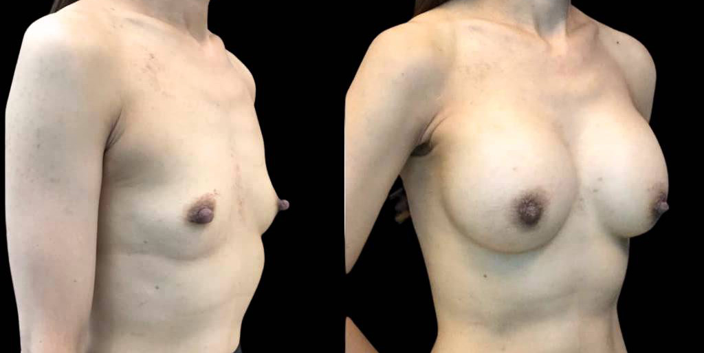 This is a 44-year-old female that has had a breast augmentation and implant showing the before and after's side-by-side