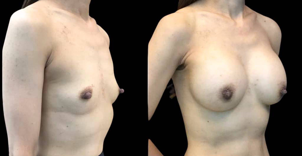 44-year-old-female-nipple-reduction-before-and-after-three-quarter-view.jpg