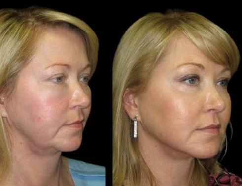 44-year-old-female-non-surgical-facelift-before-and-after-three-quarter-view.jpg