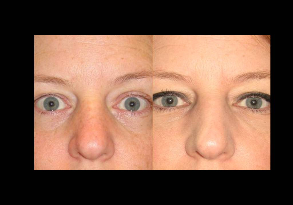 44-year-old-female-restylane-before-and-after-front-view-10228.jpg