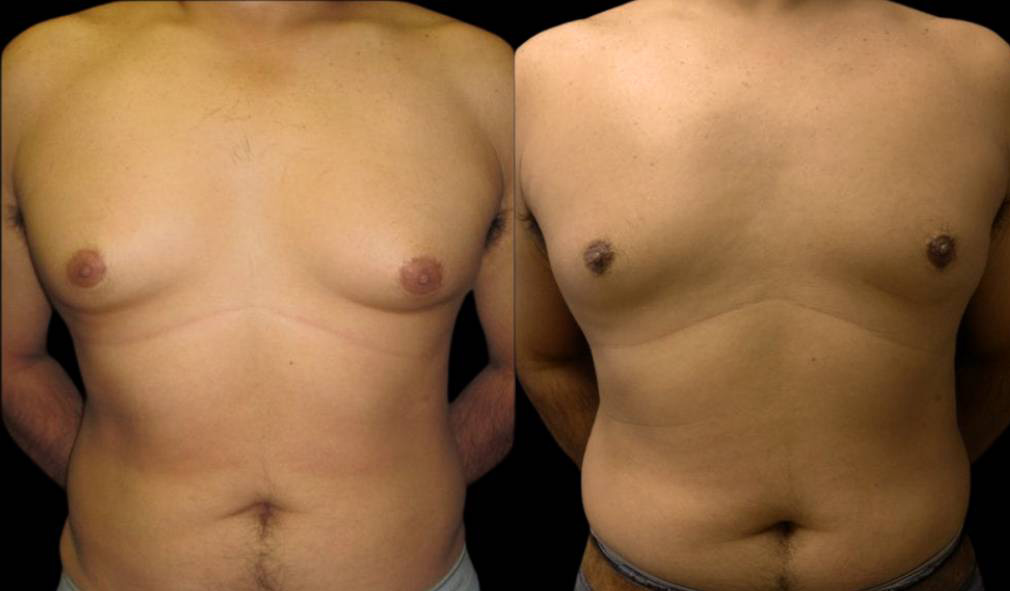 44-year-old-male-breast-reduction-before-and-after-front-view-15264.jpg
