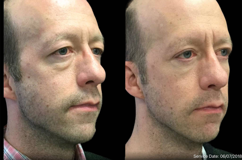 44-year-old-male-upper-and-lower-eyelid-lift-before-and-after-1.jpg