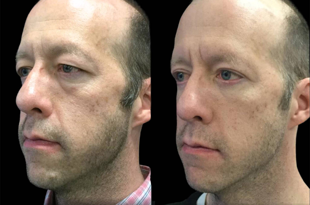 44-year-old-male-upper-and-lower-eyelid-lift-before-and-after-2.jpg