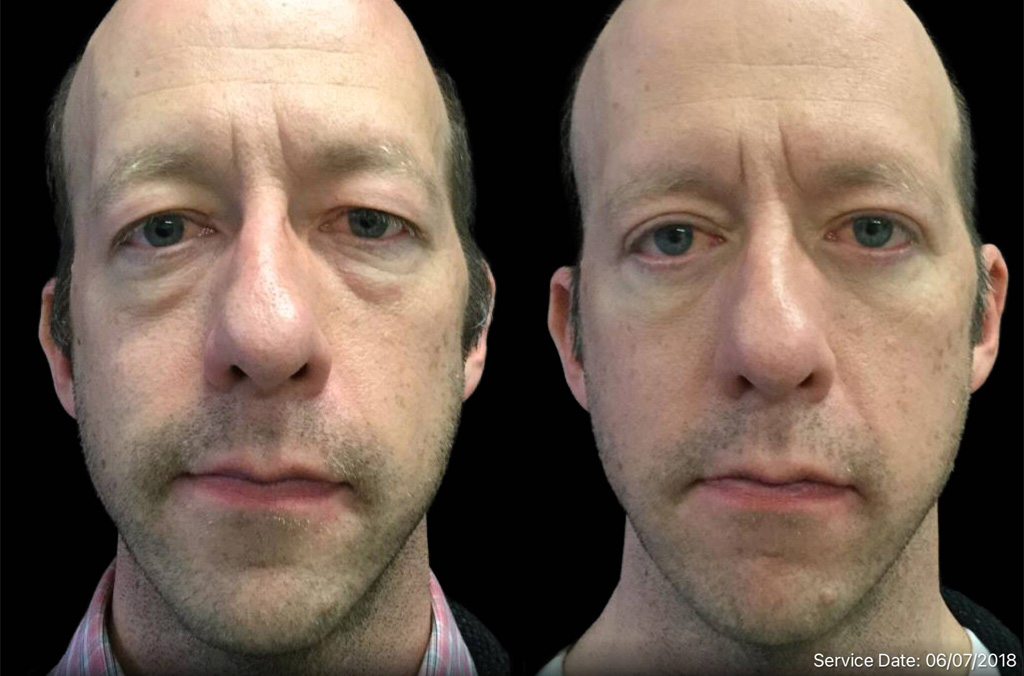 44-year-old-male-upper-and-lower-eyelid-lift-before-and-after.jpg