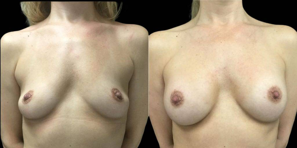 This is a 45-year-old female that has had a breast augmentation and implant showing the before and after's side-by-side