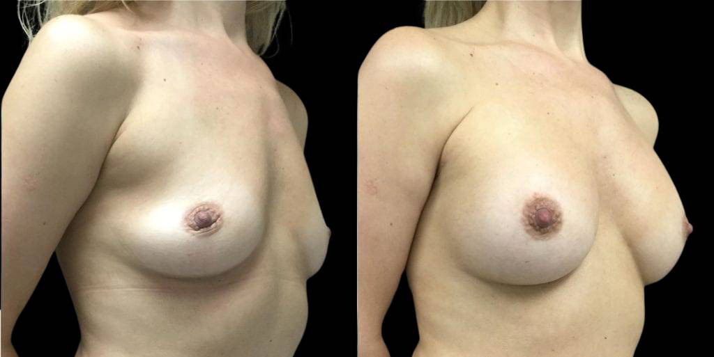 This is a 45-year-old female that has had a breast augmentation and implant showing the before and after's side-by-side