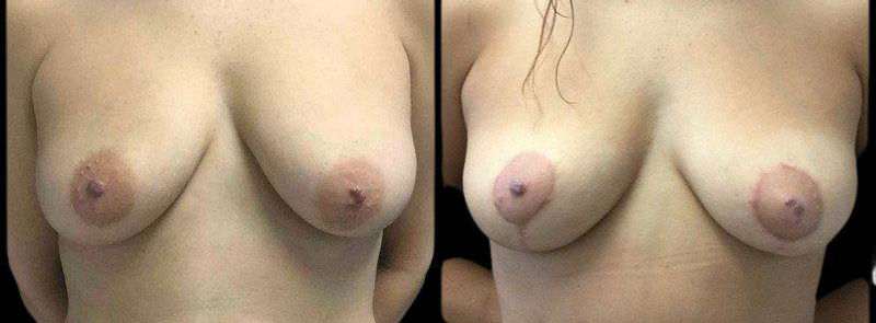 This is a 45-year-old female that has had an arm lift after weight loss showing the before and after's side-by-side