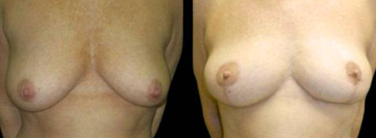 This is a 45-year-old female that has had an arm lift after weight loss showing the before and after's side-by-side