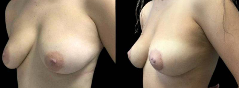 This is a 45-year-old female that has had an arm lift after weight loss showing the before and after's side-by-side
