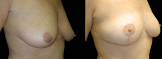 This is a 45-year-old female that has had an arm lift after weight loss showing the before and after's side-by-side