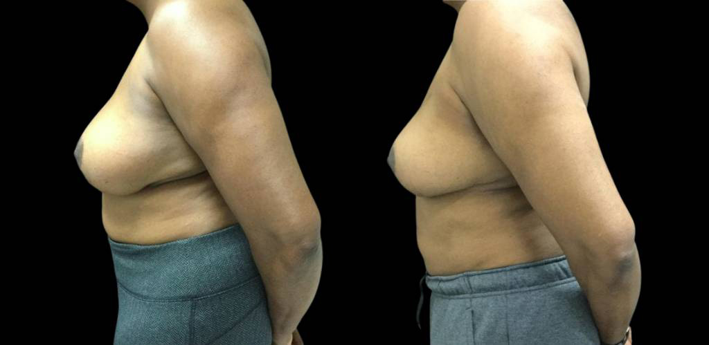 45-year-old-female-breast-reduction-before-and-after-side-view.jpg