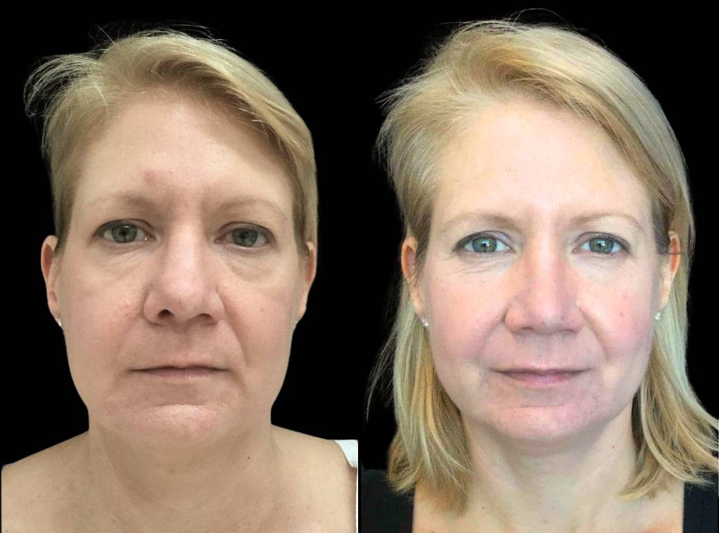45-year-old-female-rhinoplasty-before-and-after-front-view.jpg
