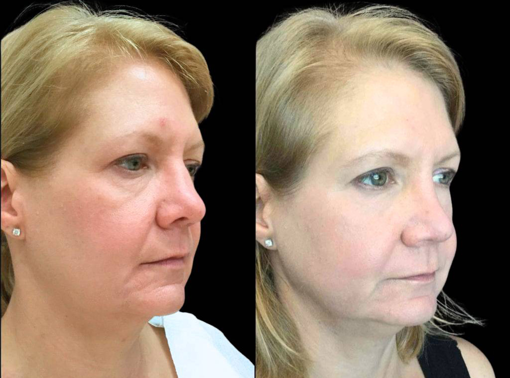 45-year-old-female-rhinoplasty-before-and-after-three-quarters-view.jpg