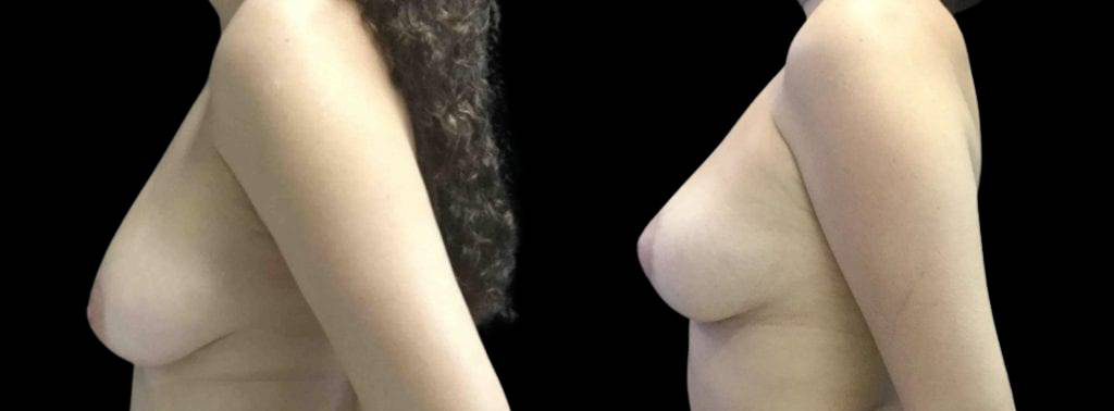 This is a 45-year-old female that has had an arm lift after weight loss showing the before and after's side-by-side