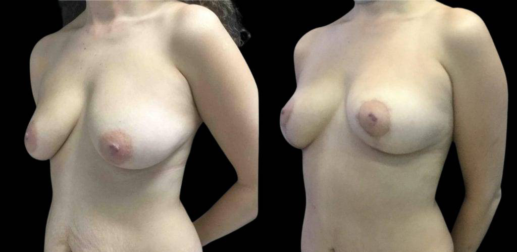 45-year-old-female-tummy-tuck-before-and-after-three-quarter-view.jpg