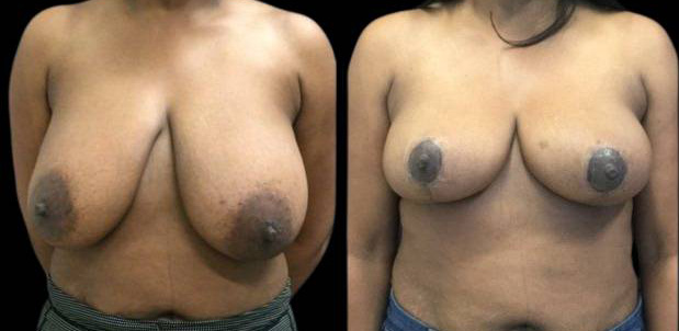 46-year-old-female-breast-reduction-before-and-after-front-view-1.jpg
