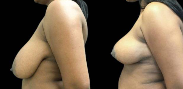 46-year-old-female-breast-reduction-before-and-after-side-view.jpg