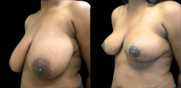 46-year-old-female-breast-reduction-before-and-after-three-quarter-view-1.jpg